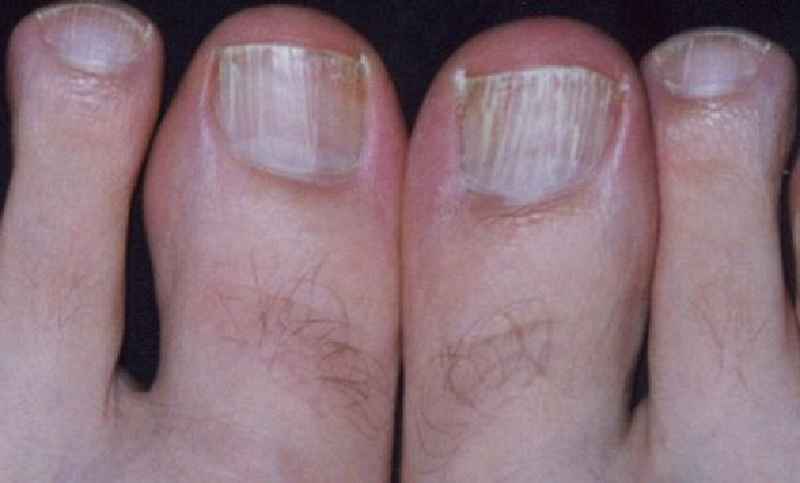 Why do I keep getting ingrown toenails on my big toe