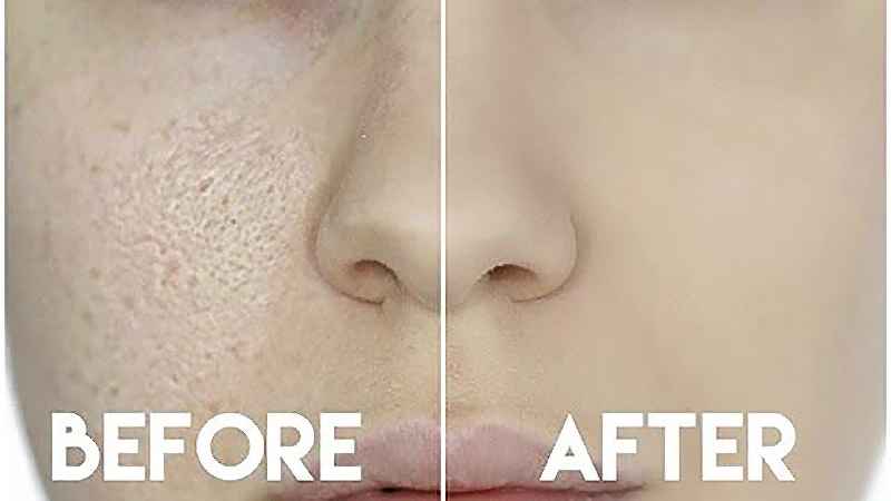 Why do my pores look bigger after microneedling