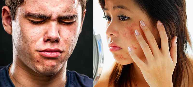 Why do teenagers get acne