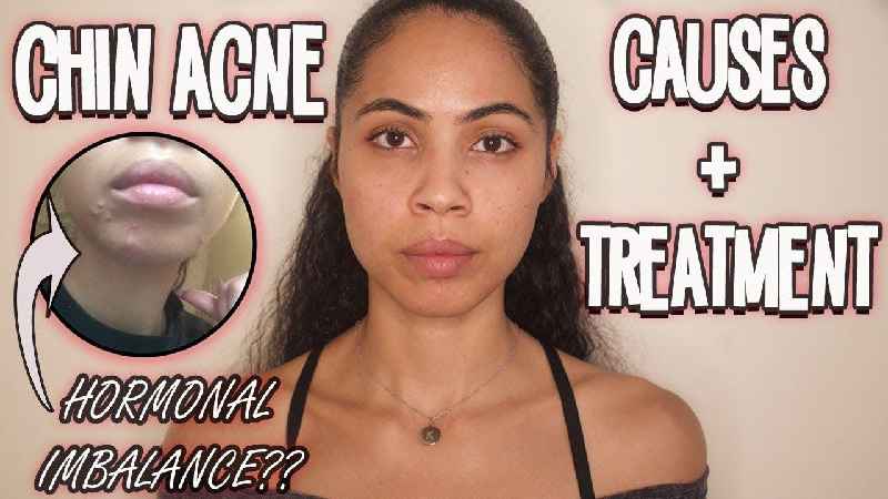 Why do teens get acne