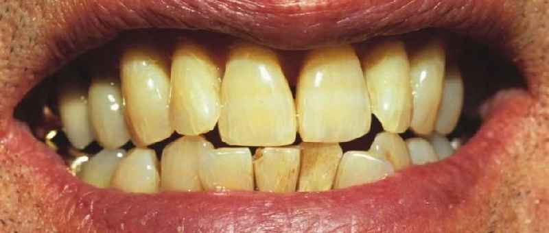 Why do teeth turn yellow