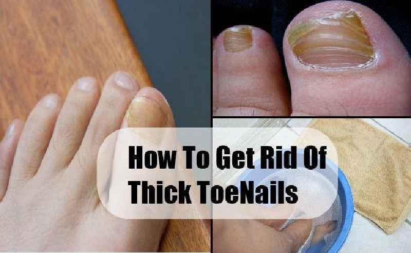 Why do toenails get fungus