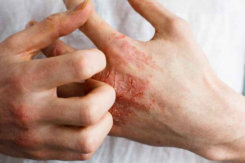 Why is eczema worse at night