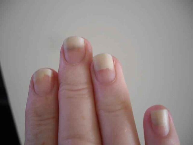 how-to-care-for-a-nail-that-is-detached