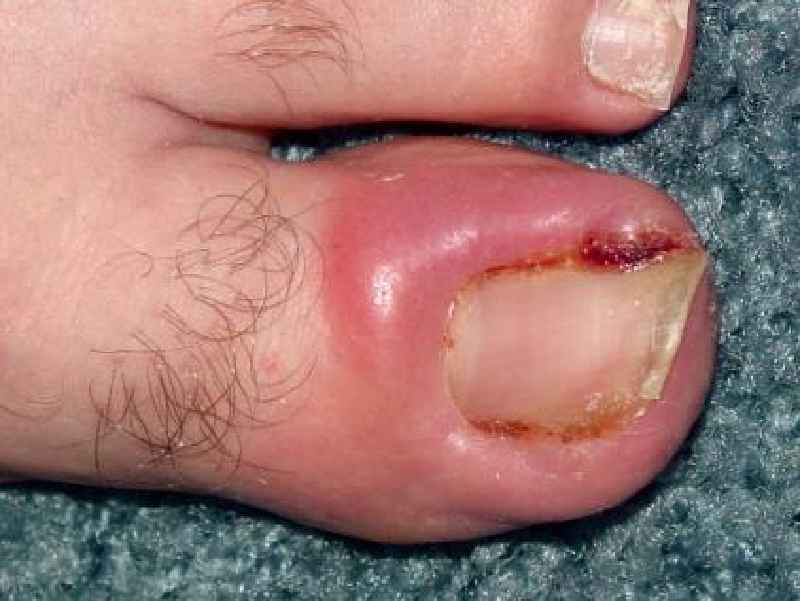 Why is my toe throbbing after ingrown toenail removal