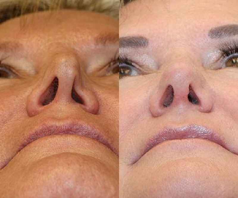 Why is nose surgery called rhinoplasty