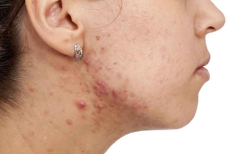 Why pimples are coming on face