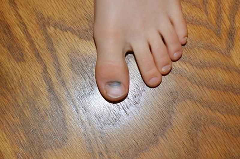 Will a dead toenail fall off on its own