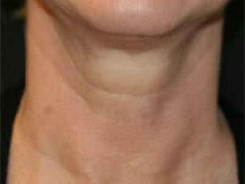 Will a neck lift get rid of horizontal lines