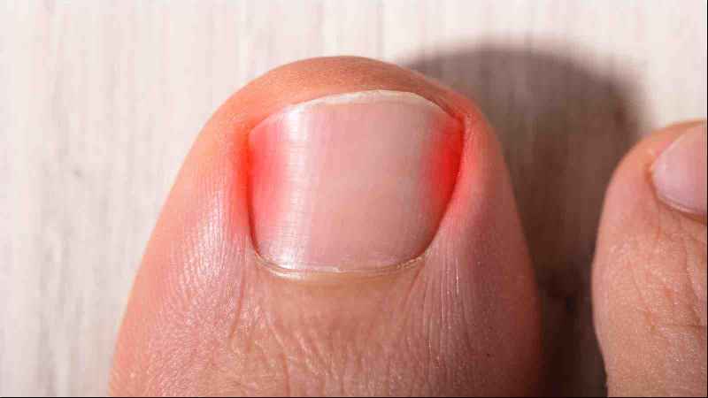 Will an ingrown nail fix itself