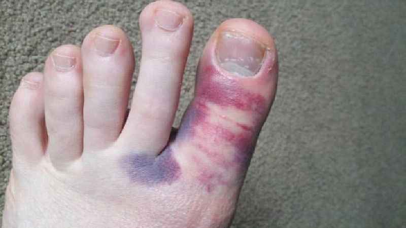 Will broken toenail heal itself