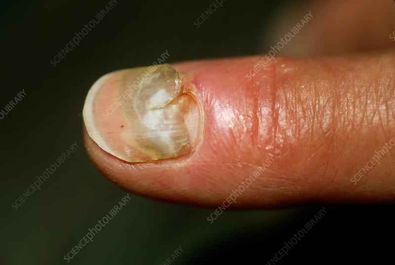 Will damaged nail bed grow back