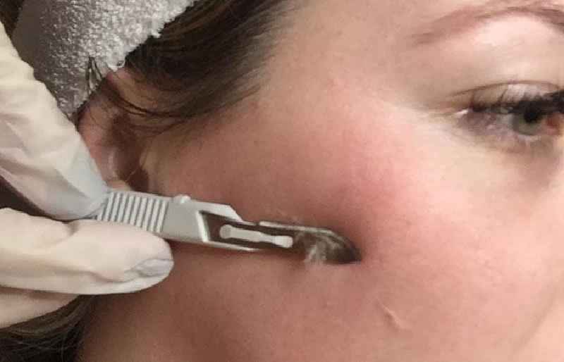 Will dermaplaning remove chin hair
