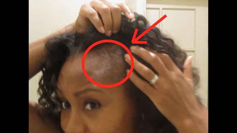Will hair loss from shampoos grow back