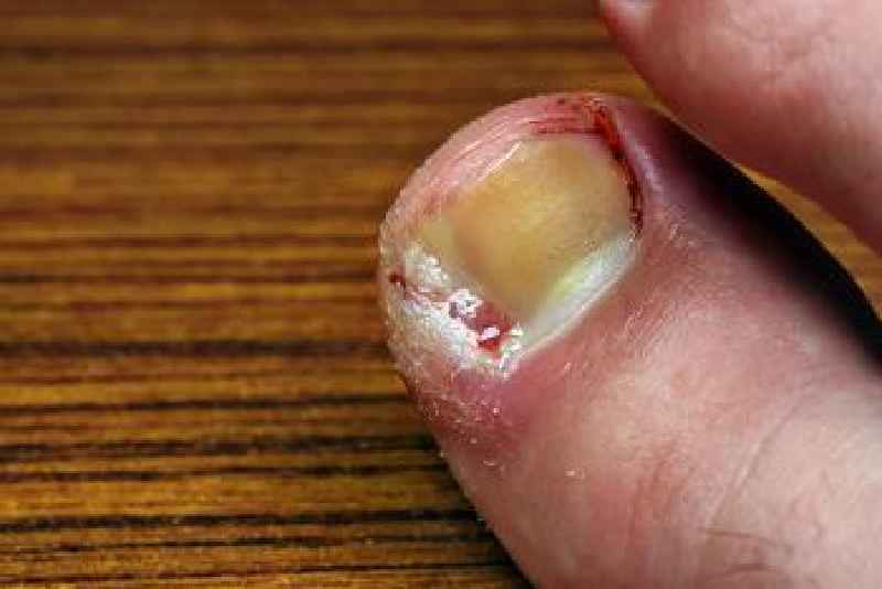 Will ingrown toenail heal itself