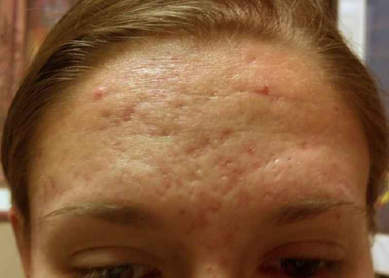 Will Microneedling get rid of frown lines