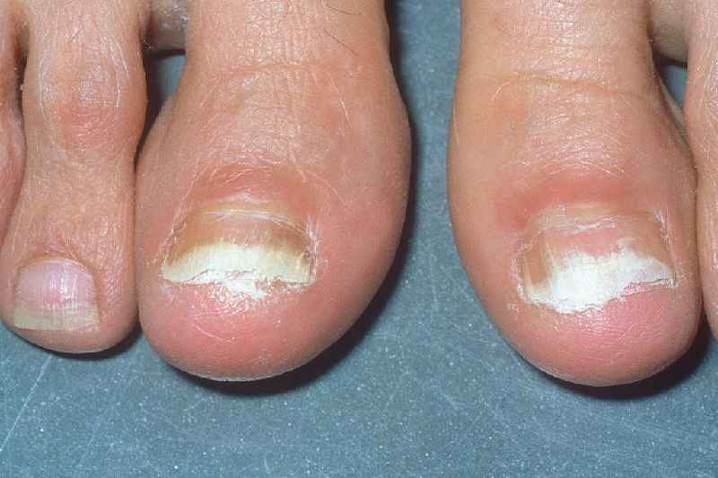 Will toenail fungus grow out